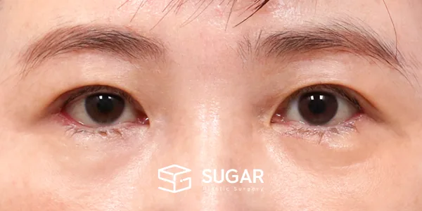 슈가성형외과 첫) 뒤밑트임 전후사진 - 수술 후
