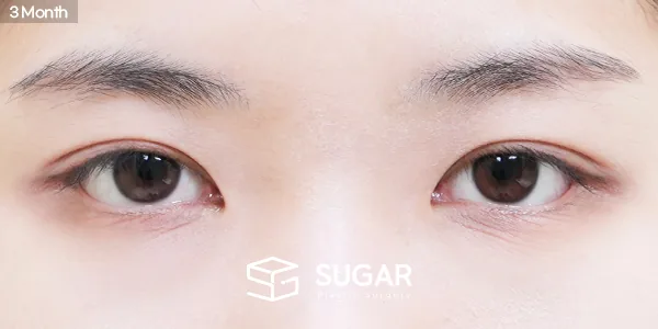 슈가성형외과 재) 재수술 + 자연유착 + 눈매교정 + 윗트임 + 뒤밑트임 전후사진 - 수술 후