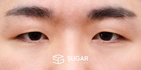 슈가성형외과 첫) 자연유착 + 눈매교정 전후사진 - 수술 전