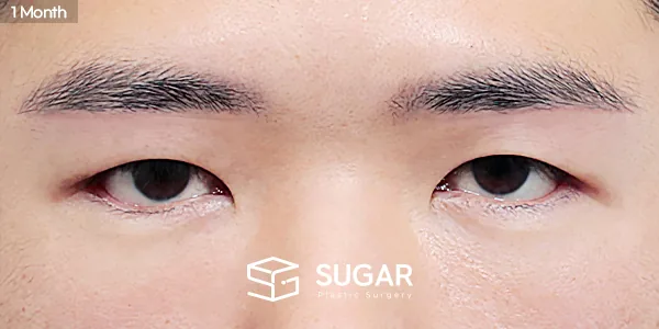 슈가성형외과 첫) 눈썹하거상술 + 뒤밑트임 전후사진 - 수술 후