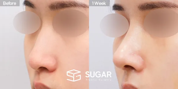 슈가성형외과 첫) 콧대 + 코끝 + 매부리코 + 복코 + 절골 + 비중격 + 귀연골 전후사진 - 45도 수술 전후 비교