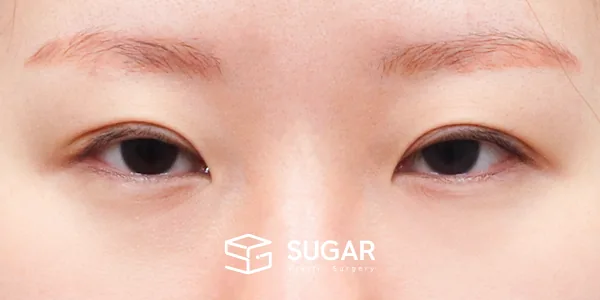 슈가성형외과 첫) 절개 + 눈매교정 전후사진 - 수술 전