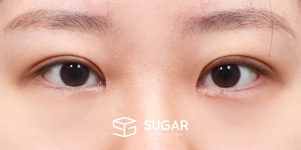 슈가성형외과 첫) 절개 + 눈매교정 + 앞트임 + 윗트임 + 눈 위 지방 제거 전후사진 - 수술 후