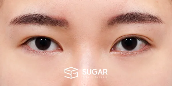 슈가성형외과 재) 재수술 + 뒤밑트임 전후사진 - 수술 전