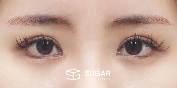 슈가성형외과 첫) 절개 + 눈매교정 + 윗트임 + 뒤밑트임 전후사진 - 수술 후