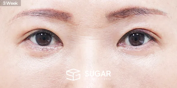 슈가성형외과 첫) 눈매교정 + 눈썹하거상술 + 상안검 + 하안검 + 중안면부거상 전후사진 - 수술 후