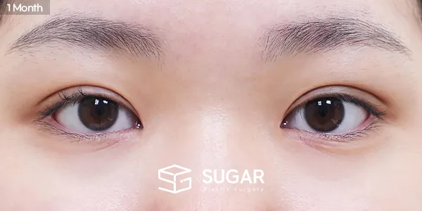 슈가성형외과 첫) 자연유착 + 눈매교정 + 앞트임 + 윗트임 전후사진 - 수술 후