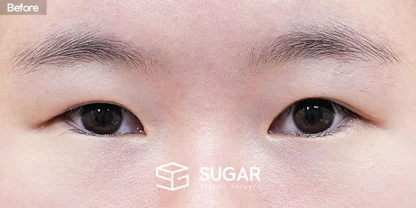 슈가성형외과 재) 재수술 + 절개 + 눈매교정 + 뒤밑트임 전후사진 - 수술 전
