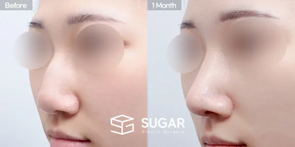 슈가성형외과 첫) 무보형물+비중격연장+매부리코+절골+복코 전후사진 - 45도 수술 전후 비교