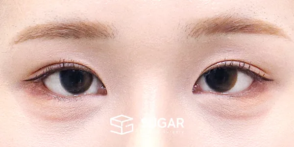 슈가성형외과 재) 재수술 + 자연유착 + 뒤밑트임 전후사진 - 수술 후