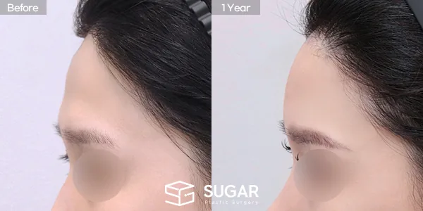 슈가성형외과 첫) 이마필러 전후사진 - 전후 비교 사진