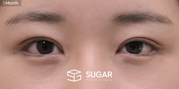 슈가성형외과 첫) 비절개눈매교정 + 윗트임 + 웨이브뒤밑트임 전후사진 - 수술 후