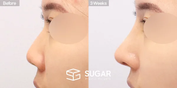 슈가성형외과 첫) 콧대 + 코끝 + 매부리코 + 짧은코 + 비중격 + 귀연골 전후사진 - 측면 수술 전후 비교