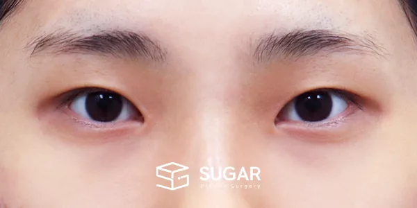슈가성형외과 첫) 자연유착 + 눈매교정 + 윗트임 + 뒤밑트임 전후사진 - 수술 전