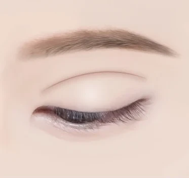 두줄따기 눈 재수술 — 수술 전