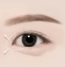 앞트임 수술방법 01 디자인