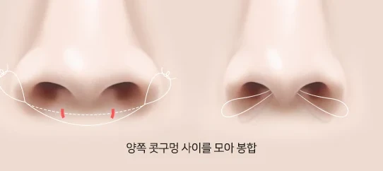 비절개 콧볼축소 — 양쪽 콧구멍 사이를 모아 봉합