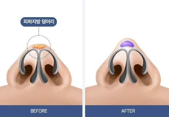 복코 CASE2 코끝 피부가 두꺼운 경우 전후