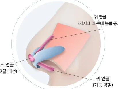무보형물 코성형 — 귀 연골로 콧대·코기둥·코끝 교정