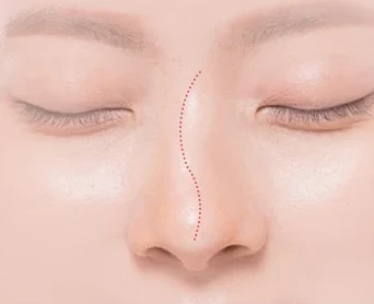 코재수술 원인 — 콧대가 휘어져 보이는 경우