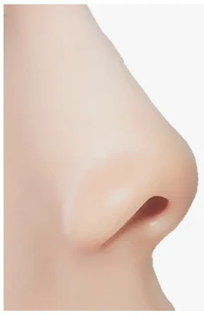 짧은코 성형 수술 전