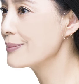 안면거상 수술방법 03 고정·봉합