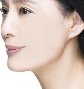 안면거상 수술방법 04 완성