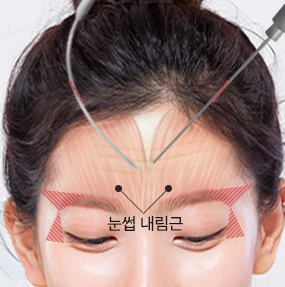 내시경 이마거상 03 눈살근·눈썹 내림근 교정